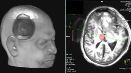 Left, a 3-D reconstruction of the patient's head wearing the ultrasonic device. Right, a cross-section view of the device, the patient's brain and the target (the thalamus), in red. Source: MARTIN M. MONTI/UCLA