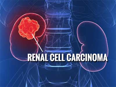 Renal Cell Carcinoma Standard Treatment Guidelines Medical Dialogues