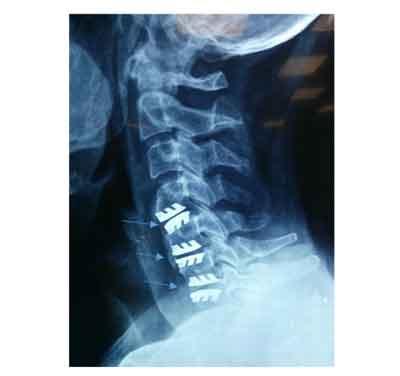 Cervical Spine Surgery Cost in India, Disc Replacement