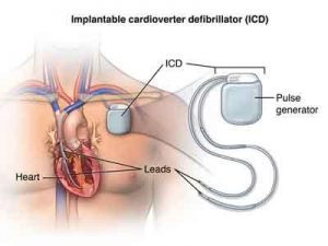 High survival rate for elderly patients with ICDs: JACC study