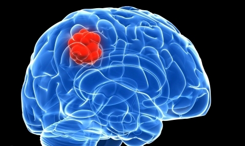 New method to kill brain cancer with skin cells