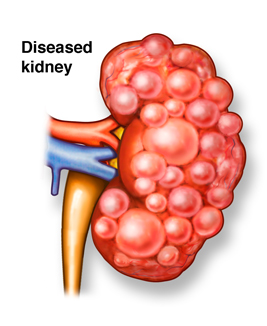 Kidney Functions decline more rapidly in  diagnosed Diabetics