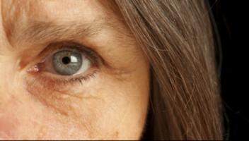 Eye calcifications an indicator of age-related macular degeneration