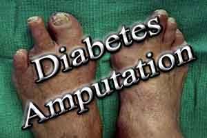 Diabetic foot amputations may be avoided with silver nanoparticles : Study