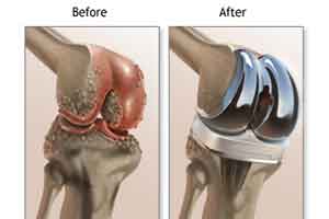 New Delhi : Pin-less computer navigated total knee replacement performed