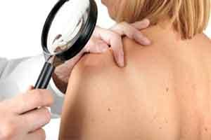 Most Melanomas Not Malignant Transformation of Moles