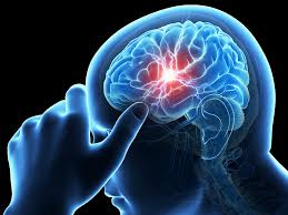 Status epilepticus in brainstem stroke: Artery of percheron infarct?