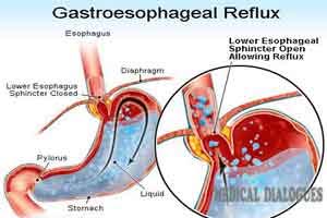 Acid reflux associated with head and neck cancers in older adults