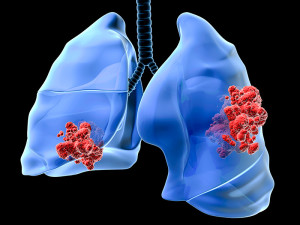Largest genome-wide study of lung cancer susceptibility identifies new causes