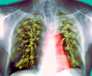 Must add vitamin D with DOTS treatment in pulmonary tuberculosis