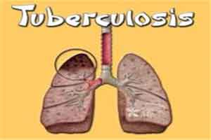 Rapid Test for MDR Tuberculosis: NEJM