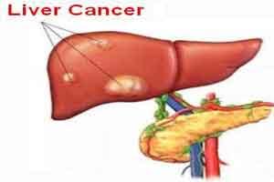 A metabolic pathway that feeds liver cancer