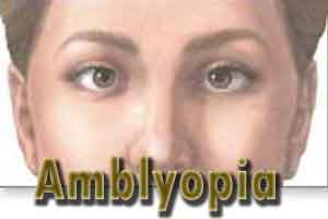 Shutter eyeglasses to replace eyepatch in amblyopia