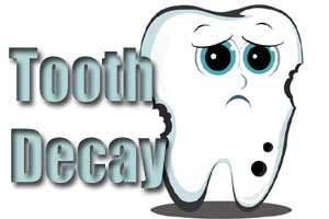 New antibacterial fillings may combat problem of recurring tooth decay, antibiotic resistance