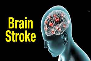 DEFUSE 3 trial-Brain-scan guided emergency stroke treatment beneficial, says NEJM Study