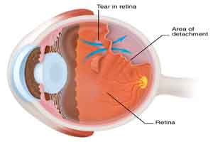 Retina may be sensitive gauge of blast-wave pressure injury