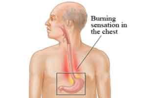 Surgery effective option for some GERD patients refractory to PPIs: NEJM