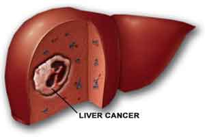 New Omega-3 trial for secondary liver cancer surgery