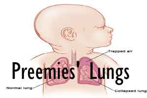 Lungs of premature babies can be examined using lasers rather than harmful Xrays