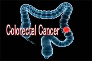 Colorectal cancer screening spares male patients from intense treatments