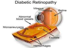 New Glowing contact lens - A potential solution for diabetic retinopathy