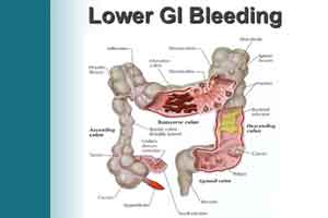 Management of acute lower GI bleeding: British Society of Gastroenterology guidelines