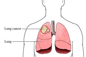 aggressive cancer in lungs)
