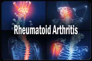 Root cause of rheumatoid arthritis may be linked to gum infections: Study