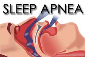 Patients with sleep apnea also suffer from GI tract conditions: Study