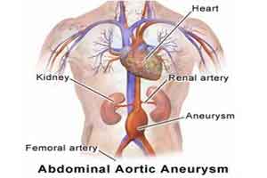 Smoking, not alcohol bigger risk factor for abdominal aortic aneurysm :  British Journal of Surgery