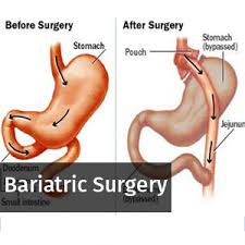 Liver fat levels effectively monitored by MRI after bariatric surgery