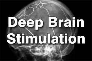 Long-term study data confirms DBS as effective treatment for most severe form of depression