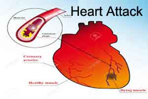 Heart failure not as life-threatening as heart attack: Experts