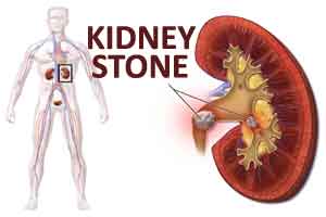 Mayo Clinic researchers develop tool to predict kidney stone formation