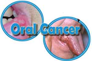 Oral cancer will account for 30% of all cancer deaths by 2020