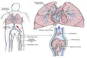 Pulmonary embolism only a rare cause of Syncope says new study