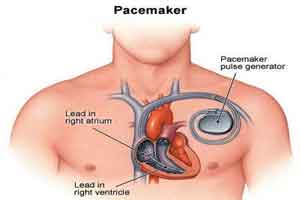 Pacemaker function may be impacted by electric appliances; tools: AHA Study