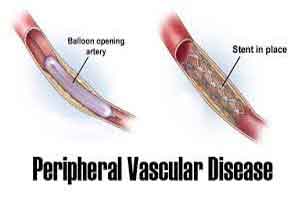 Aspirin therapy may not help patients with peripheral vascular disease, researchers find