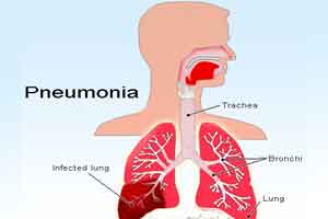 Severe Community Acquired Pneumonia - Standard Treatment Guidelines