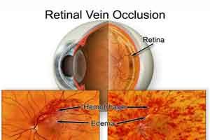 Glaucoma increases risk for retinal vein occlusion