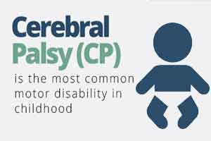 Antenatal Magnesium sulfate prevents cerebral palsy in preterm neonates