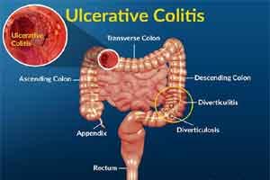 Methotrexate has no effect on remission /relapse in Ulcerative Colitis