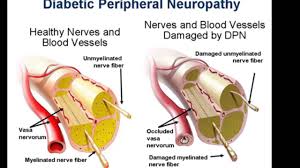 Special eye examination to detect Peripheral Neuropathy in type 2 DM