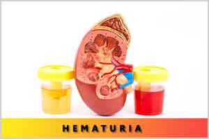 Antithrombotic medications associated with increased risk of Haematuria : JAMA