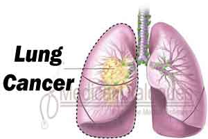 Lung cancer: Scientists find answer to resistance