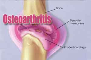 Working Indian population at growing risk of osteoarthritis