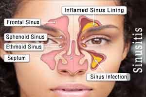 AAO-HNSF Updated Clinical Practice Guideline: Adult Sinusitis