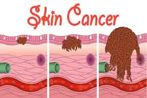 Researchers look to improve detection of skin cancer lacking pigment melanin