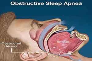 Sleep apnea patients at increased risk of gout