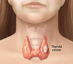 swollen neck thyroid